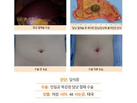 담석증수술후기. 건강검진..