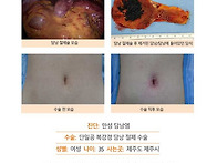만성담낭염수술후기. 갑자..