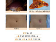 담낭용종수술후기. 요즘 ..