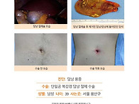 담낭용종수술후기. 원장님..