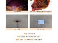 만성담낭염수술후기. 몇 ..
