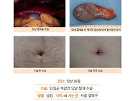 담낭용종수술후기. 원장님..