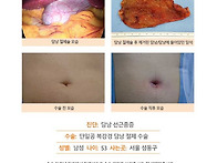 담낭선근종증수술후기. 단..