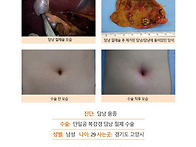 담낭용종수술후기. 대학병..