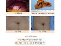 만성담낭염수술후기. 담석..