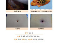 담석증수술후기. 수술 후 ..