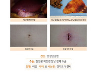만성담낭염수술후기. 건강..