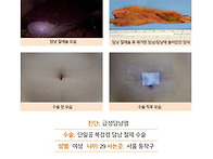 급성담낭염수술후기. 원장..
