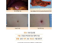 만성담낭염수술후기. 용종..
