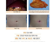 담낭용종수술후기. 수술을..