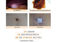 급성담낭염수술후기. 예약..