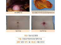 담낭선근종증수술후기. 수..