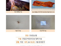 만성담낭염수술후기. 평소..