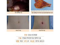 담낭선근종증수술후기. 단..