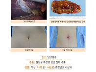 담낭용종수술후기. 소문대..