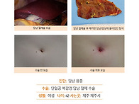 담낭용종수술후기. 년간 ..