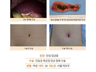 만성담낭염수술후기. 의사..