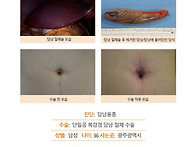 담낭용종수술후기. 건강검..