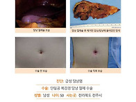 급성담낭염수술후기. "급성..