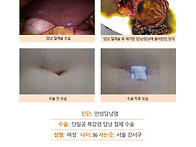만성담낭염수술후기. 김정..