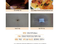 단일담석2.6cm수술후기. ..