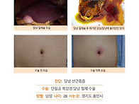 담낭선근종증수술후기. 수..