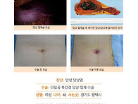 만성담낭염수술후기. 걱정..