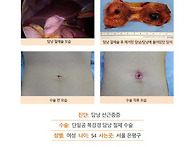 담낭선근종증수술후기. 원..