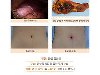 만성담낭염수술후기. 수술..