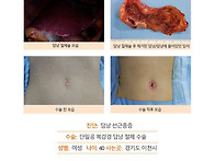담낭선근종증수술후기. 우..