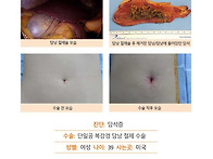 담석증수술후기. 친절하게..