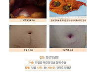 만성담낭염수술후기. 제 ..