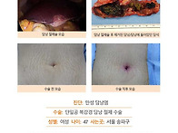 만성담낭염수술후기. 소화..