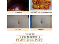 담낭용종수술후기. 진료시..
