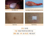 담석증수술후기. 극심한 ..