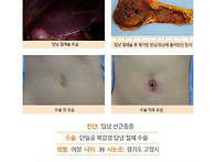 담낭선근종증수술후기. 복..