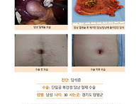 담석증수술후기. 명치 통증..