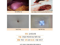급성담낭염수술후기. 너무..