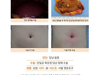담낭용종수술후기. 담낭에..