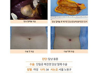 담낭용종수술후기. 타병원..