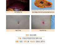 담낭용종수술후기. 걱정했..
