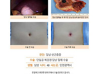 담낭선근종수술후기. 김정..