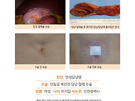 만성담낭염수술후기. 명치..