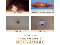 담낭선근종증수술후기. 수..