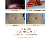담낭선근종증수술후기. 건..