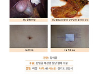담석증수술후기. 수년전부..