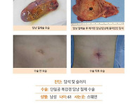 담석증수술후기. 국내 단일..