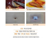 색소성담석증수술후기. 김..