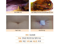 미국에서오신담낭용종환자..