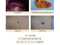 담낭용종수술후기. 초기 ..